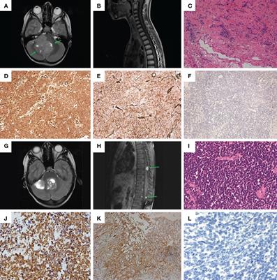 Case report: Somatic mutations in microtubule dynamics-associated genes in patients with WNT-medulloblastoma tumors